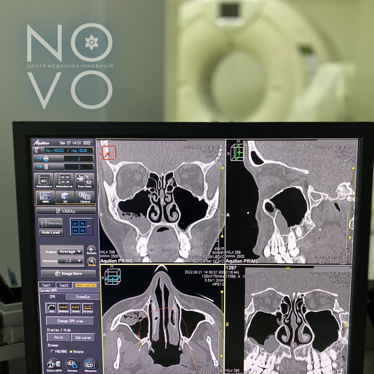 Комп'ютерна томографія приносових пазух носа у Львові в Медичному центрі NOVO